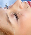 acupunctura