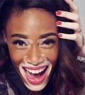 vitiligo